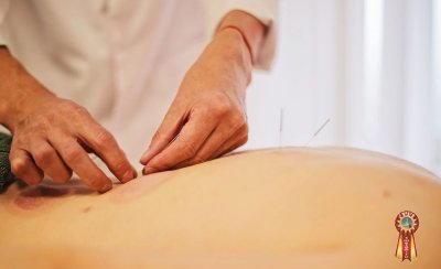 Лечение иглоукалыванием в Москве цены